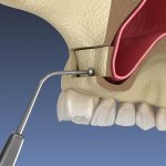 what is a sinus lift and why do i need one