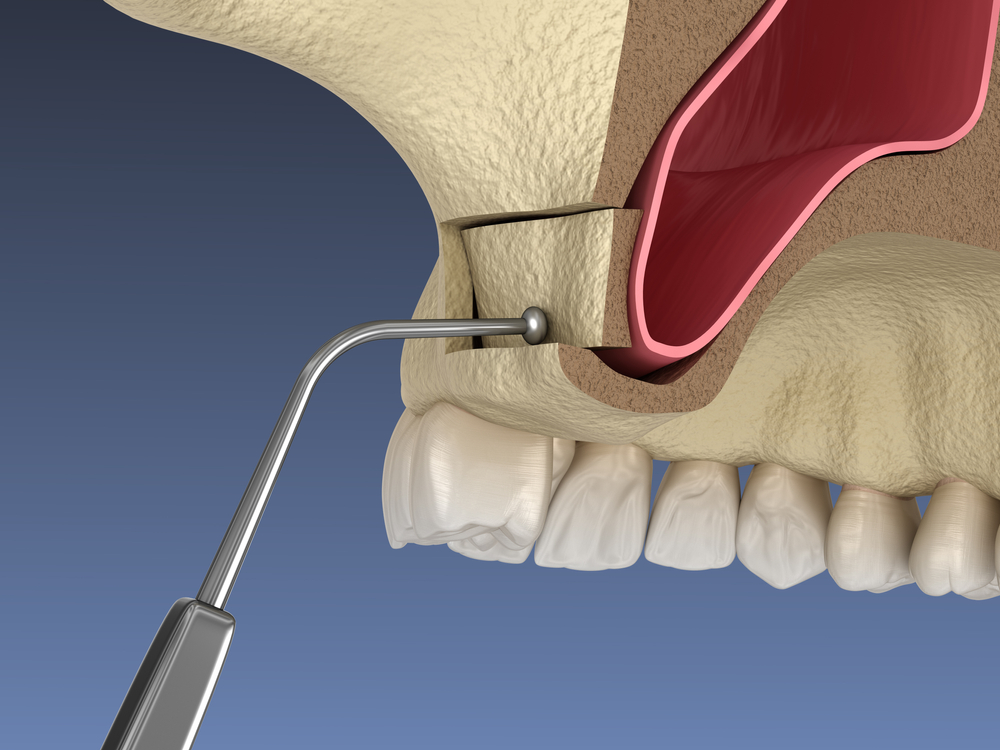 what is a sinus lift and why do i need one