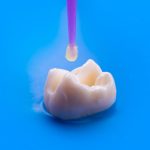 bonding fix chipped or cracked teeth