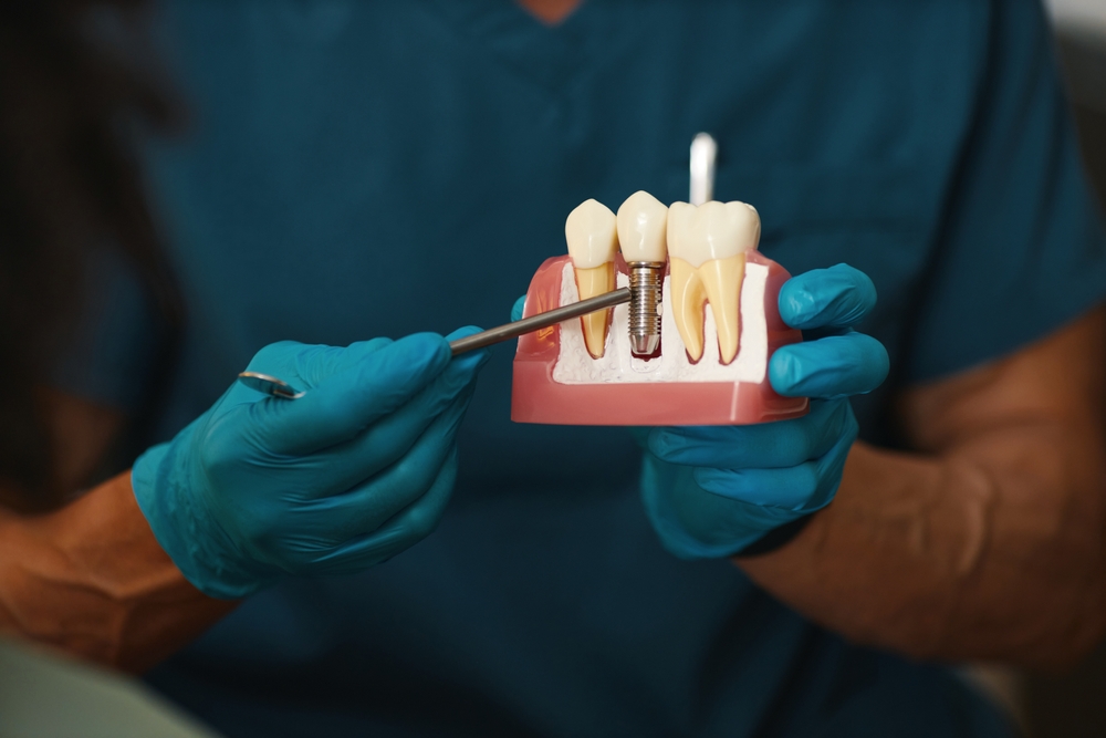 what are dental implants, and how does the dental implant process work from start to finish