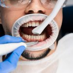 before & after dental cleaning: real results explained
