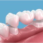 how dental bridges replace missing teeth