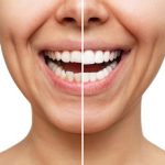 veneers before and after